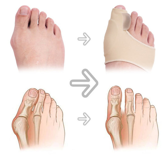 Hallux Valgus Correction Splint Bunion Corrector